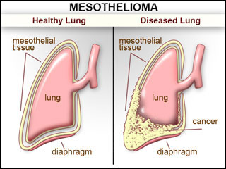 Mesothelioma and similar