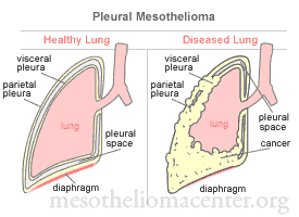 Pleural Mesothelioma